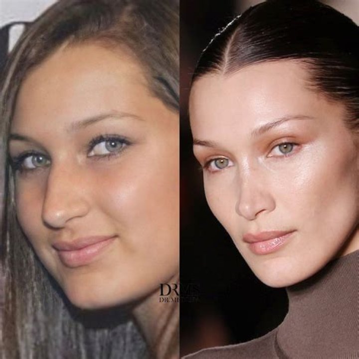 What Sort of Plastic Surgery Did Bella Hadid Actually Have? Disclosing the Details