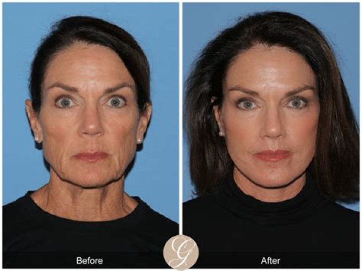 Did Ashley Judd Get A Face Lift Surgery? Before And After