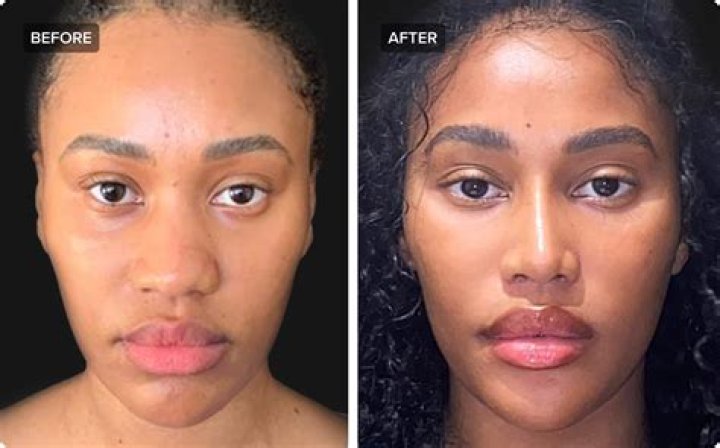 Grimes Nose Job: Before And After Photos