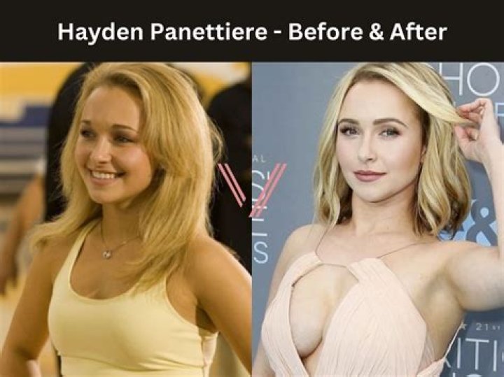 Hayden Panettiere Botox: Before And After Photos