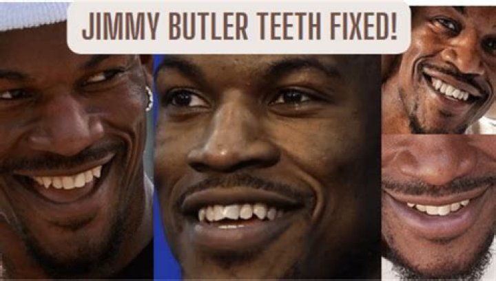 What Is Wrong With Jimmy Butler Teeth? Braces Or Whitening