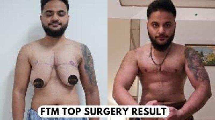 Miles McKenna Surgery: Did He Get Top And Bottom Surgery?