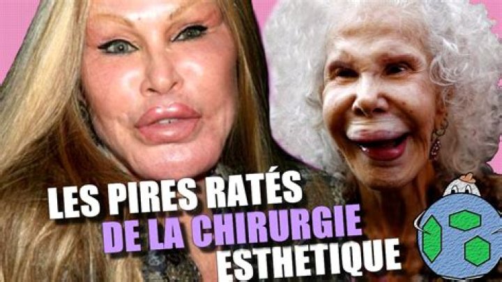 Les pires ratés de la chirurgie esthétique des stars