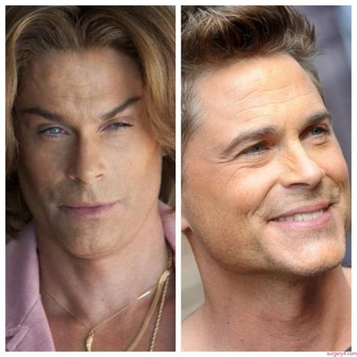 Has Rob Lowe Had Plastic Surgery Done to Maintain His Youthful Features?