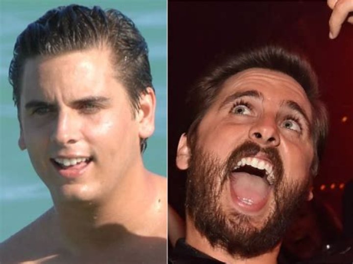 Scott Disick Plastic Surgery: Before And After Photos
