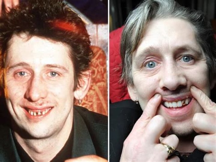 Was Shane Macgowan Weight Loss Linked To Disability? Teeth Before And After