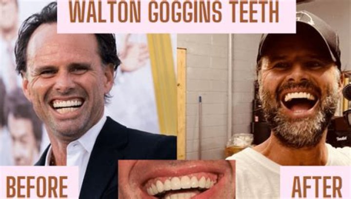 Walton Goggins Had His Teeth Shoved up His Gums When They Fell Off